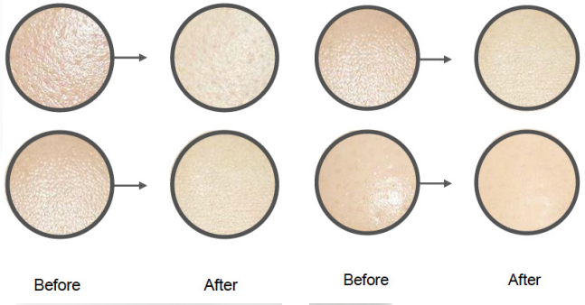 Images showing close-ups of skin texture before and after treatment, highlighting improvements in smoothness and clarity.